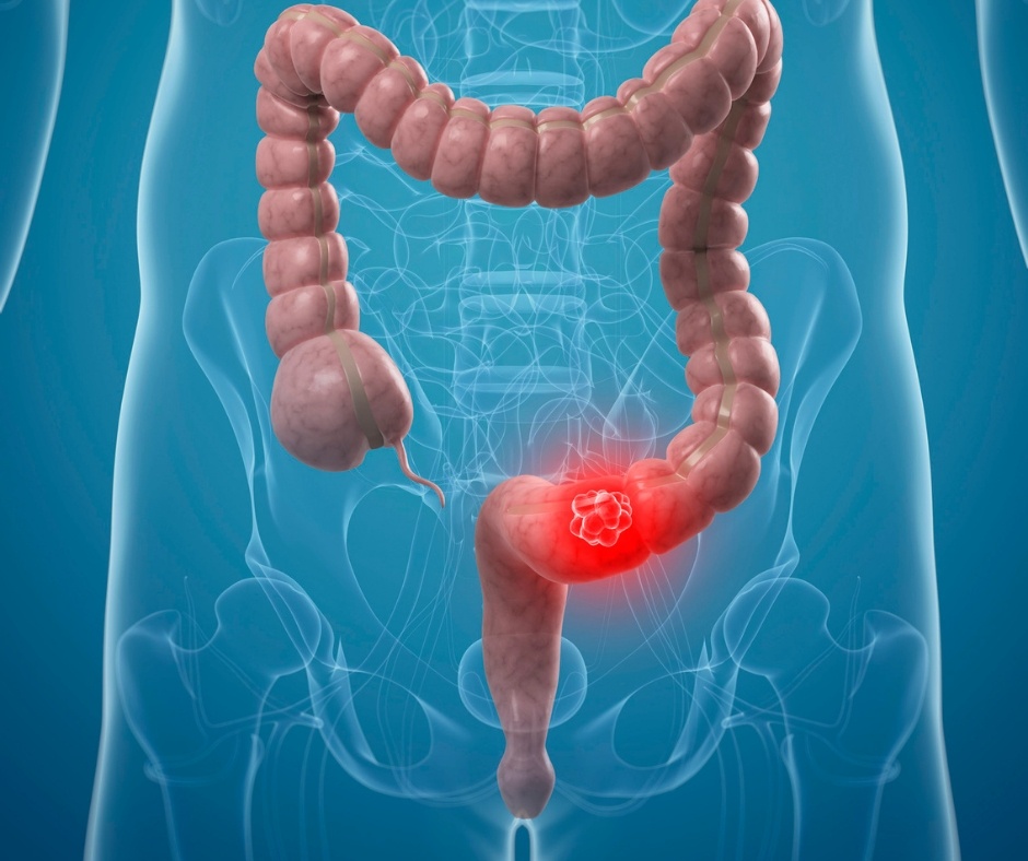 What are the Symptoms of Colon Cancer? - Yoors