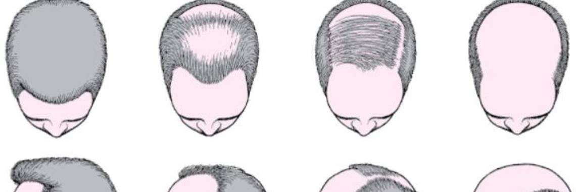 What causes Hair Loss ? What causes Hair Loss ?