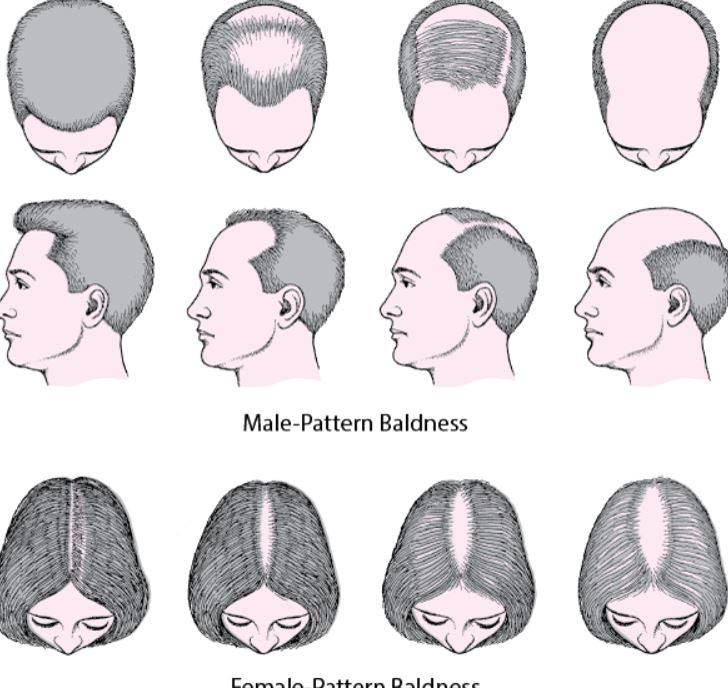 What causes Hair Loss ?