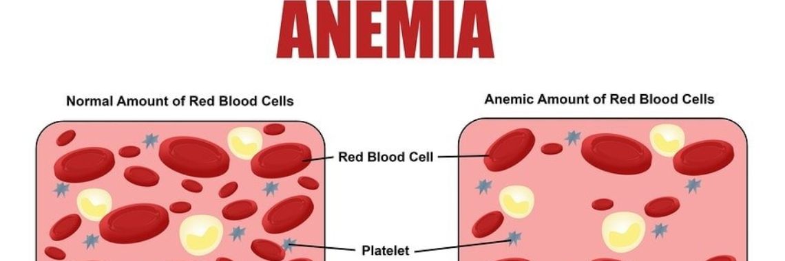 Anemia definition - Yoors