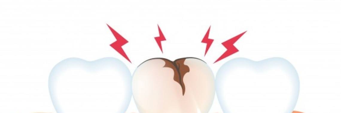 What are Cavities? | idk