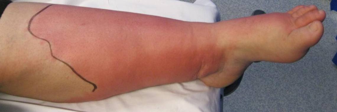 What is Cellulitis? | idk