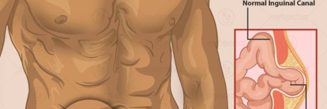 What is Hernia? | idk