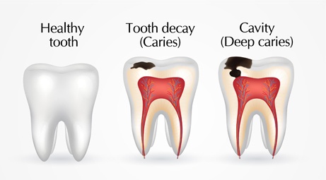 What do cavities look like? - Yoors