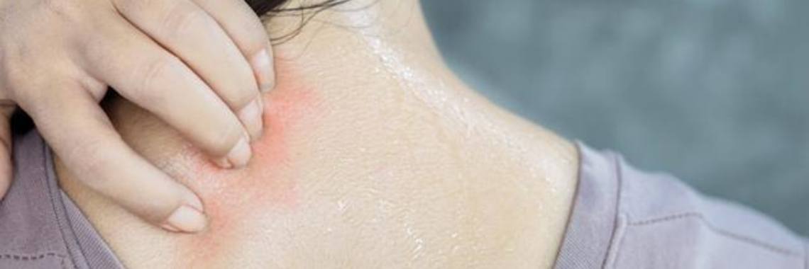 how-to-treat-heat-rash-yoors