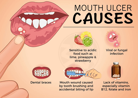 What Causes Canker Sores Yoors
