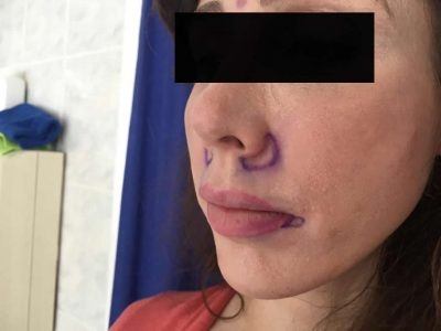 Lip Lift