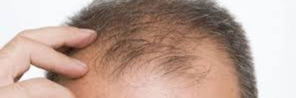 Help, mijn haren vallen uit! | Roodkapje