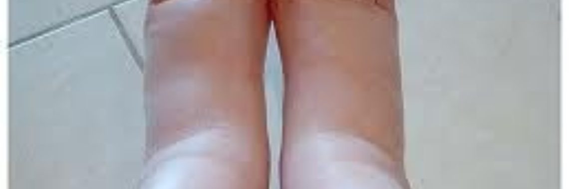 Wat is een oedeem | Roodkapje