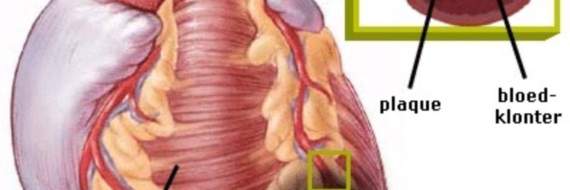 Whether or not to have sex after myocardial infarction | Roodkapje