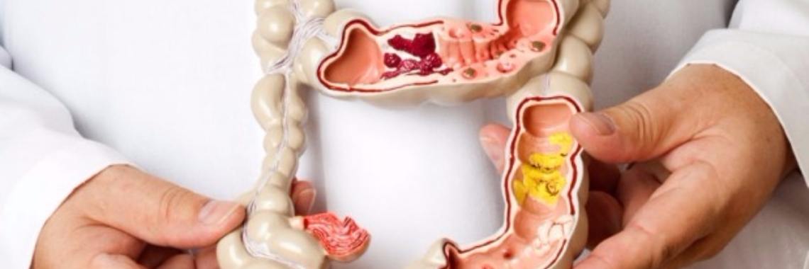 Spastic colon or irratable bowel syndrome. | bibimakeupqueen