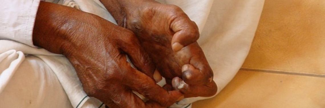 Een melaatse in de stad... | LWAlmanak