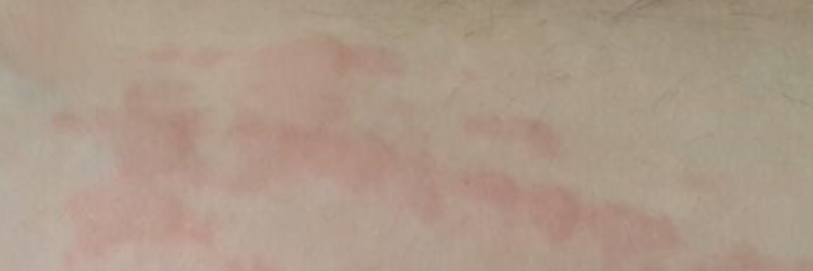 Update.....2e en 3e oorzaak gevonden!!Netelroos / Urticaria....... | Kiki Kim Hier