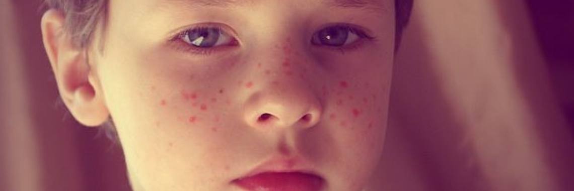 Sproetenkoning | Hans