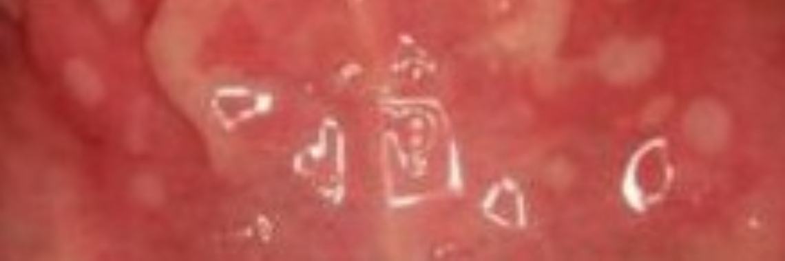 Aphthes in your mouth | Stieny Koopmans